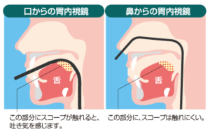 胃内視鏡(経鼻、経口)